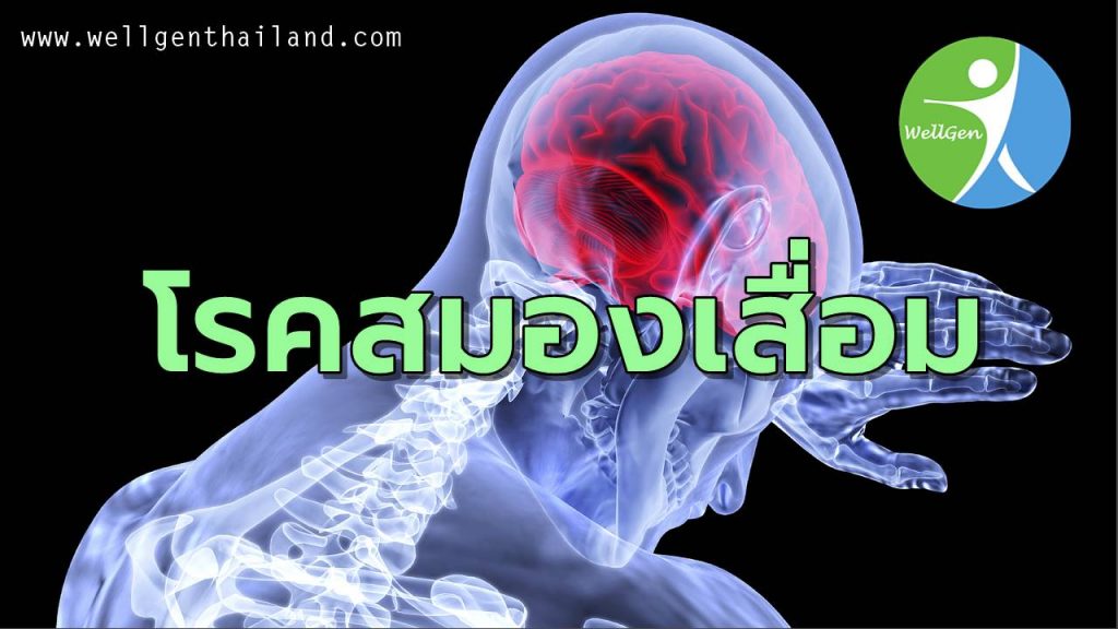 โรคสมองเสื่อมหรืออัลไซเมอร์คืออะไร