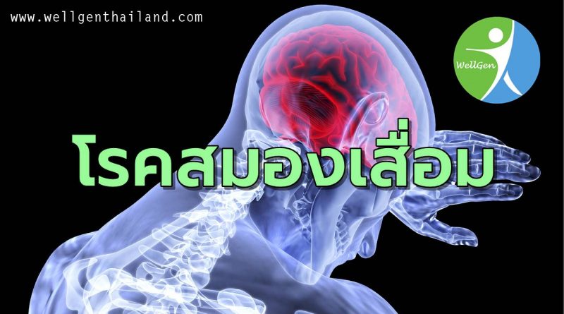 โรคสมองเสื่อมหรืออัลไซเมอร์คืออะไร