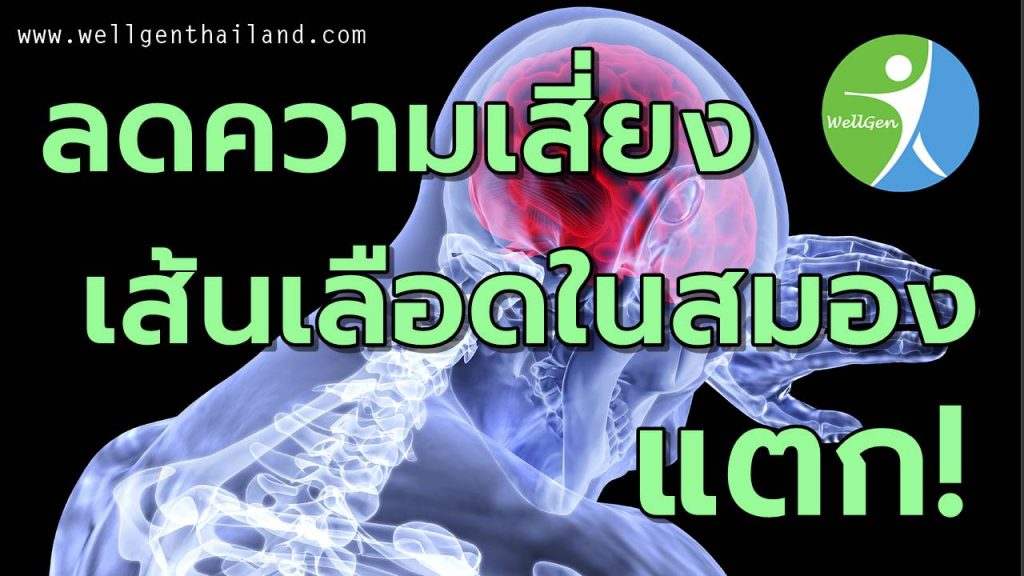 6วิธีลดเสี่ยงเส้นเลือดในสมองแตก