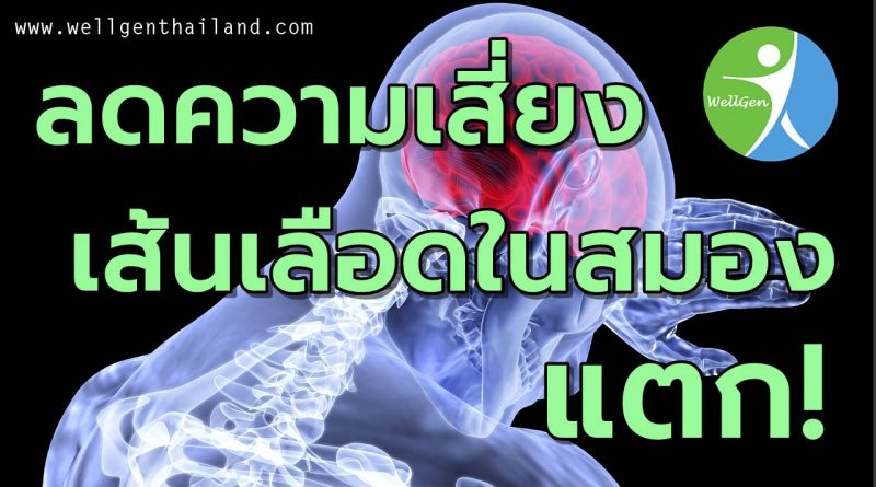 6วิธีลดเสี่ยงเส้นเลือดในสมองแตก