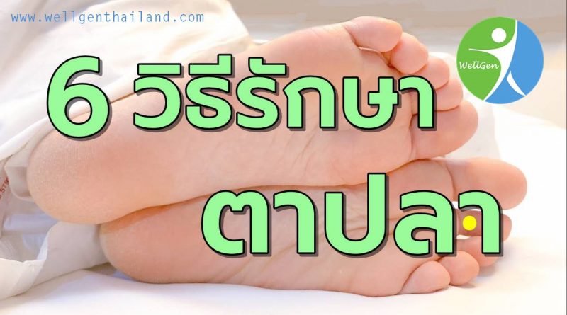 6วิธีรักษาตาปลาที่ฝ่าเท้า