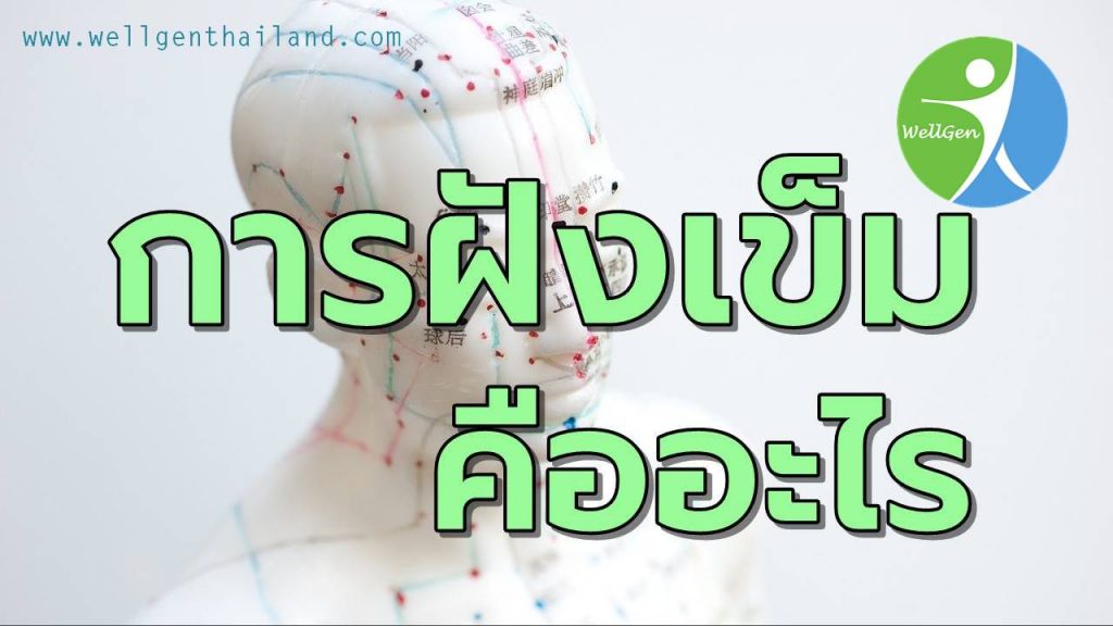 แพทย์ทางเลือกการฝังเข็ม คืออะไร