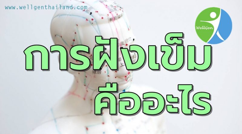 แพทย์ทางเลือกการฝังเข็ม คืออะไร