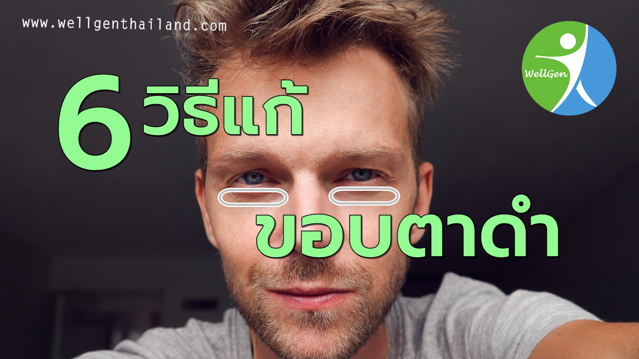 6วิธีแก้อาการขอบตาดำคล้ำ 6วิธีแก้อาการขอบตาดำคล้ำ